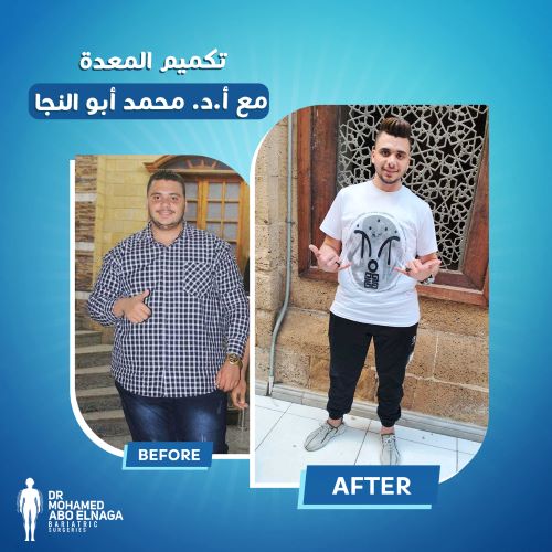 تجاربكم مع تكميم المعدة 3